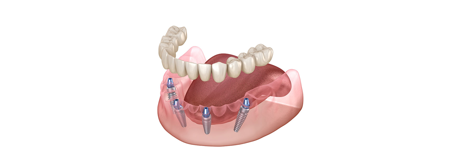 The image displays a set of dentures with visible teeth and gum detail against a white background.
