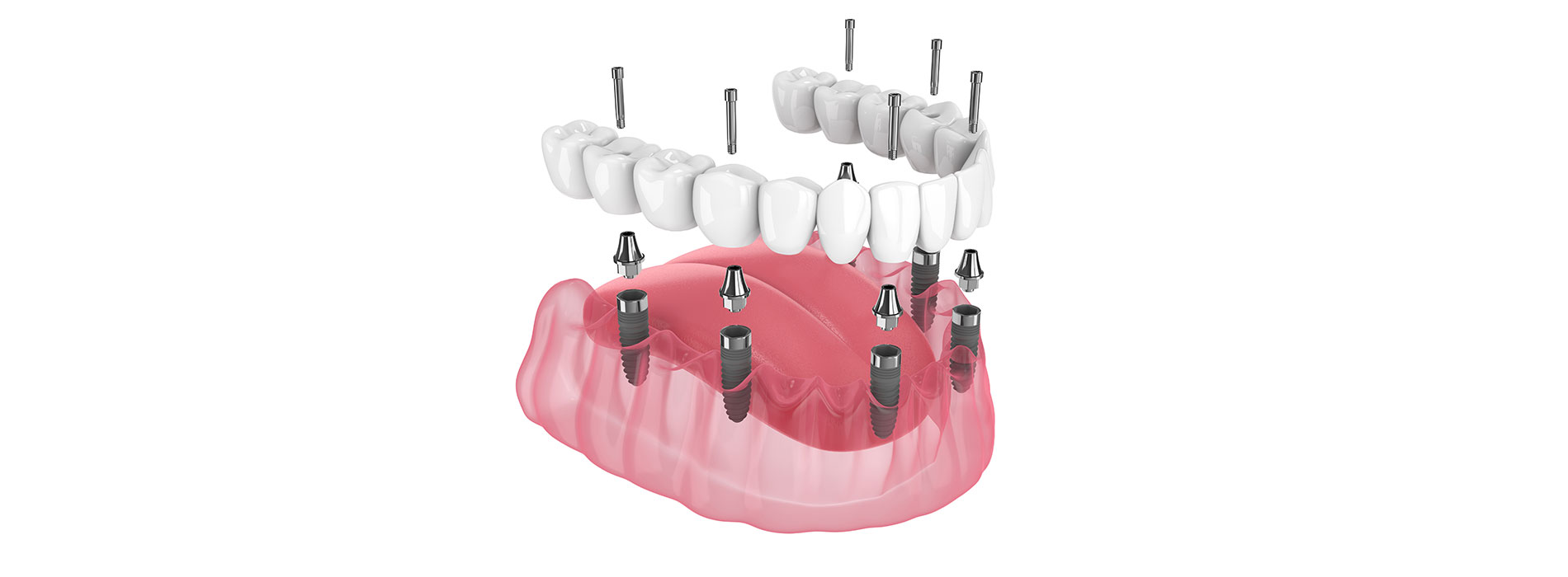 The image shows a set of teeth with several missing pieces, presented against a light background.