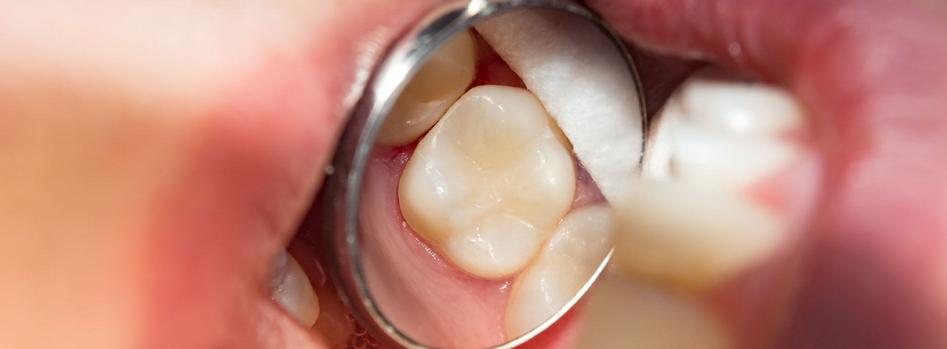 An extreme close-up of a person s mouth with multiple teeth showing signs of decay, featuring a large ring piercing through the lower lip, set against a blurred background.