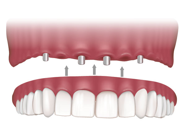 The image displays a side-by-side comparison of a natural human tooth and its corresponding dental implant, illustrating the transformation process from one to the other with an arrow pointing from the upper to lower teeth.