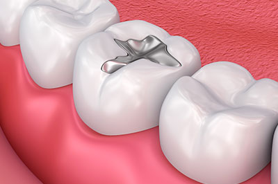 The image shows a 3D rendering of a human tooth with a small silver ring embedded in its enamel, placed against a background that appears to be a red surface, possibly representing a gumline.