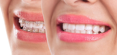 The image shows a close-up of a person s smiling face with teeth and lips clearly visible against a white background, emphasizing oral hygiene and dental care.