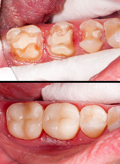 The image shows a close-up view of a person s mouth with teeth and gums, highlighting dental issues such as decay and discoloration, with an  alt  tag that could read  Dental decay and staining in a patient s mouth.