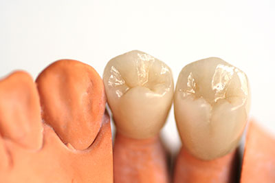 The image shows a set of human teeth with visible enamel wear, placed next to each other on a white background, possibly for dental education or comparison purposes.