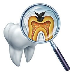 The image shows a stylized illustration of a tooth with an open crown and a magnified view of its interior, where we can see a detailed cross-section revealing the structure of the teeth, including the pulp chamber, dentin layers, and a cavity with decayed enamel.
