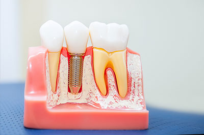 The image shows a model of human teeth with dental implants, featuring visible screws and tooth-like structures, placed on a pink base that resembles a gumline.