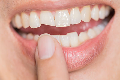 The image shows a person s smiling face with crooked teeth and a missing tooth, holding a finger near their mouth, which is focused on a close-up of a dental implant.