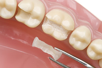 The image shows a close-up view of a dental implant with a metal screw visible through an opening in the crown, set against a background that appears to be a mouth model.