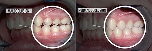 The image shows a person s teeth undergoing a dental procedure, with a focus on the process of malocclusion correction.