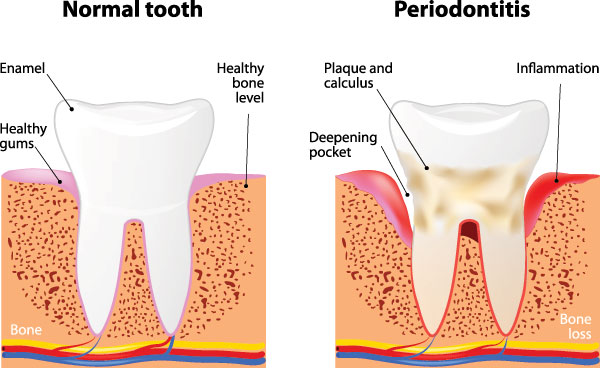 The image displays two diagrams labeled  Normal tooth  and  Periodontitis.  It illustrates the differences between healthy gums and inflamed, diseased gums, with annotations indicating a healthy pocket of gum tissue, a pocket of pus, and bone loss in the affected area.