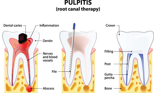 The image displays a detailed illustration of a human tooth structure labeled with various parts, such as pulp, root canal therapy components, and dental caries, set against a background that appears to be a simplified cross-section of a tooth.