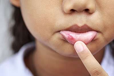 The image shows a close-up of a person s face with a noticeable pimple on their chin, looking directly at the camera with a finger pointing towards the blemish.