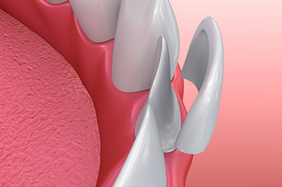 The image shows a close-up view of a mechanical dental implant with a pink gum base and metallic components, set against a blurred background.