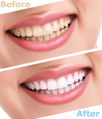 The image shows a before-and-after comparison of teeth whitening, with two photos of a person s smile side by side, showing a significant improvement in tooth color after treatment.