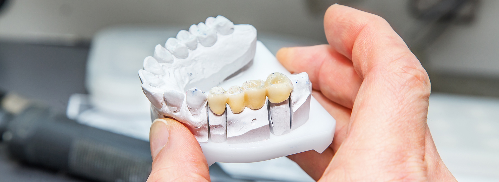 The image shows a person holding a set of white teeth with gold accents, possibly indicating dental work such as crowns or implants being performed or prepared for placement.
