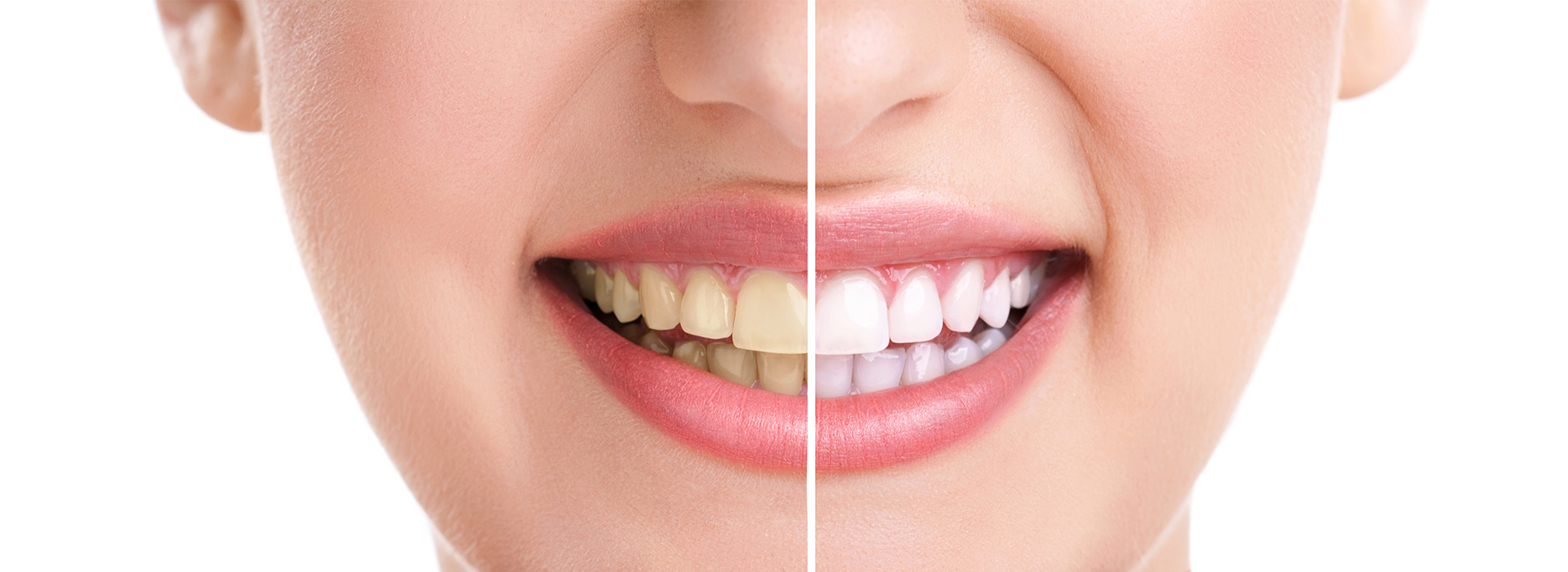 The image features a close-up view of a person s face with a focus on their teeth, showcasing a dental product or service.