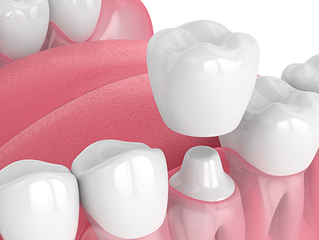 The image displays a close-up view of multiple dental implants with pink gums against a white background.